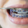 Brace_Face