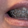 Bracesx3
