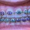 BracedAgain12