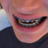 BraceFace79