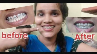 3 mahine ka new update total gap closed 😱😱😱 #youtube #video #vlog