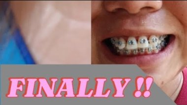 FINALLY !! GOT MY BRACES NA 😭 THANK YOU DOC MIA FOR MAKING IT HAPPEN PO 🥺😭😍🥰 I AM SO HAPPY#braces