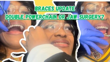 Braces Update | Will I have to get jaw surgery???