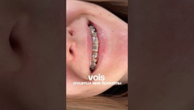 VOIS оплатил мне брекеты 🦷⚙️ УЗ #бьюти #vois #брекеты #стоимость