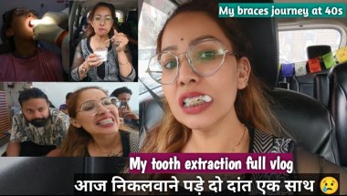 My braces journey at 40s/tooth extraction/braces treatment /braces on teeth/braces @kiandkalifevlogs