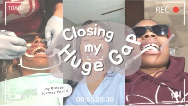 Closing My Huge Gap 🦷 Pt. 2