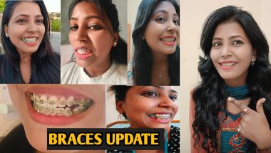 My Braces Journey || Braces Update || Braces Vlog 2025 / Nd Family Vlogs