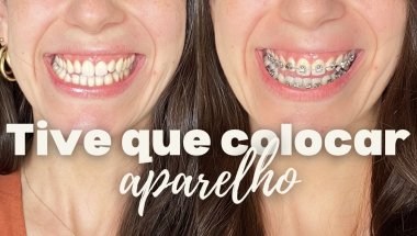 🌟 Colocando Aparelho Autoligado: como foram os 3 Primeiros Dias! 🌟