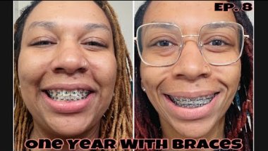 Double Power Chains • Revenge Of The Gaps • Transformation • Braces Journey Update • 2025