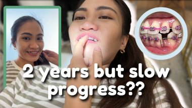 April 2025 Braces Update | premolar gaps | moving wire | dental fillings