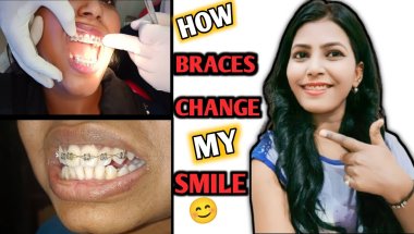 Teeth Braces Before And After Face Change || How Braces Change My Smile 😊 || Nd Family Vlogs