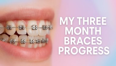 Braces Progress at 3 Months
