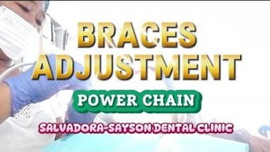 Braces Adjustment POWER CHAIN ⛓️ | Green 💚 @charmainesumilang8061 #fypyoutube