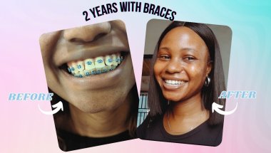 2 Years, 1000 Smiles: My Braces Journey Explained