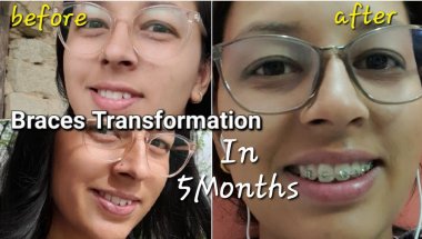Braces Transformation |All Details Of Braces | #viralvideo #youtubevideo #bracesoff #braces #Braces