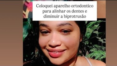 COLOQUEI APARELHO ORTODONTICO PARA ALINHAR MEUS DENTES E Biprotrusão