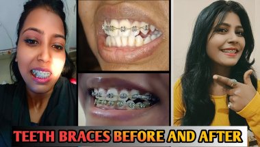 Braces Journey 😊 || Teeth Braces Before And After || Braces Update || Nd Family Vlogs