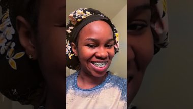 My braces Journey #braces #bracestreatment #openbite #orthodonticstreatment