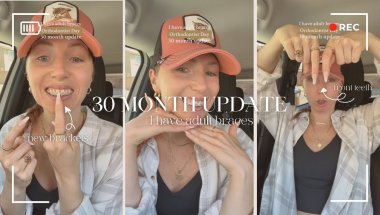 30 month update for my adult braces