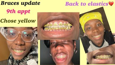 Braces update : after appointment 9