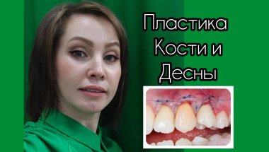 #27 Костная и мягкотканная пластика. До или После ЧЛХ??? 9 месяцев после операции.