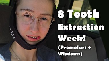 Tooth Extraction Week! (#braces VLOG)
