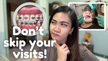 Braces Adjustment: Everything You Need to Know