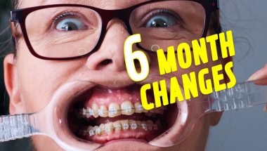 Big Changes After 6 Months with Braces!