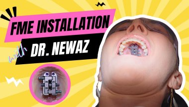 FME Surgery Unveiled: The Complete Installation Process with Dr. Newaz