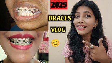 My Braces journey 😊| Braces Vlog | Nd Family Vlogs #braces #bracesjourney