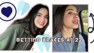 Getting Braces at 22