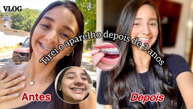 FINALMENTE…. TIREI O APARELHO DEPOIS DE 3 ANOS + CONTENÇÃO