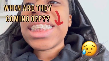 Another BRACES TIGHTENING APPOINTMENT | Getting tired?