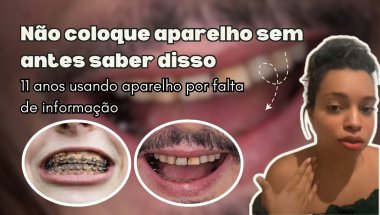 Não coloque aparelho sem antes saber disso.