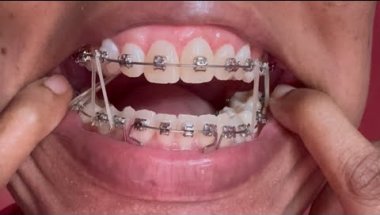 NEW WIRE SAME RUBBER BAND PLACEMENT