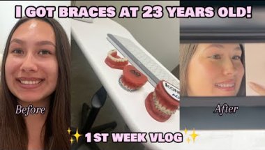 GETTING BRACES AT 23 YEARS OLD! | Iconix Braces