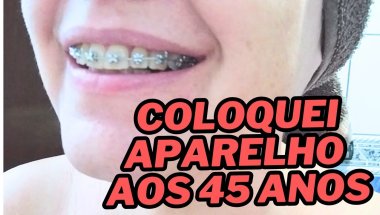 Coloquei aparelho ortodôntico aos 45 (Quase 46) 😂 como está sendo os primeiros dias