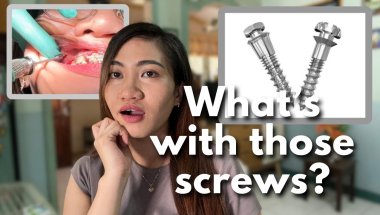 TADs: The small screw that could speed up your treatment!