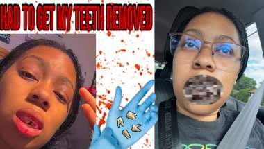 I had to get my teeth removed… it’s so painful