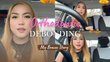 ORTHODONTIC DEBONDING | MY BRACES STORY | JACK MENDOZA