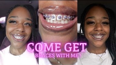 Getting Braces at 20+: My Honest Experience!