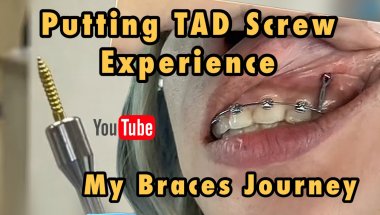 Attaching TAD / Screw for Braces (11 months on braces)