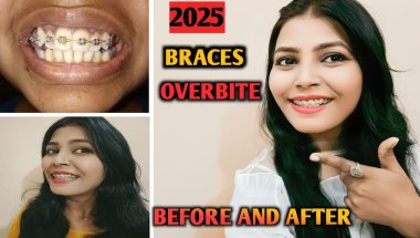 Braces Overbite Before And After 2025 || Braces Journey || Nd Family Vlogs