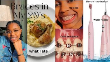 Braces in My 20s: The Why, The How & The Real Tea" Adult Braces Journey Begins! GLOWING UP #braces