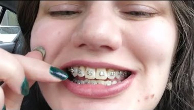 Braces Journey Update 5/15/25