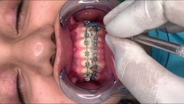 🔥BRACKETS - FRENILLOS - BRACES - FRENOS🔥