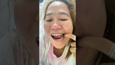 Story time about my Brace 😁 Naka Deep Bite pala ako.