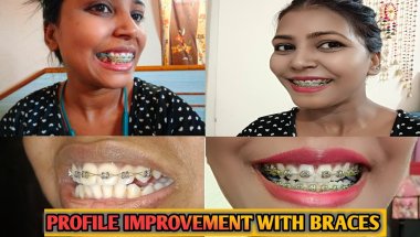 Profile Improvement With Braces 2025 || Braces Journey || Nd Family Vlogs