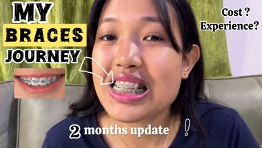My braces journey : 2 months update !