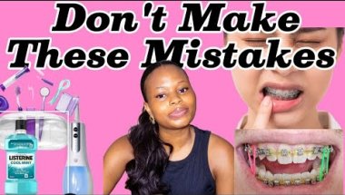 10 Things to Know Before Getting Braces/ Price, Color, Hygiene & More (i wish someone told me these)